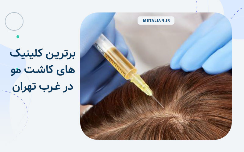 کلینیک های کاشت مو در غرب تهران