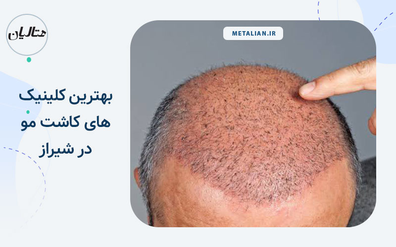 بهترین کلینیک های کاشت مو شیراز