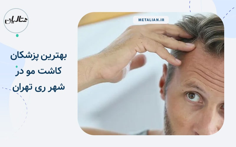 بهترین دکترهای متخصص کاشت مو در شهر ری تهران