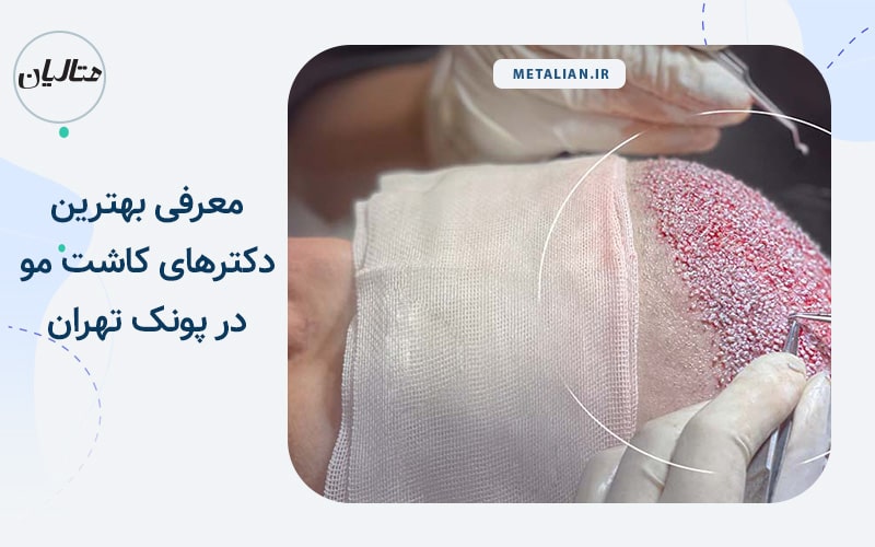 معرفی بهترین دکترهای کاشت مو در پونک تهران