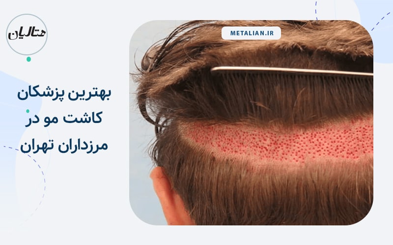 بهترین دکترهای متخصص کاشت مو در مرزداران تهران