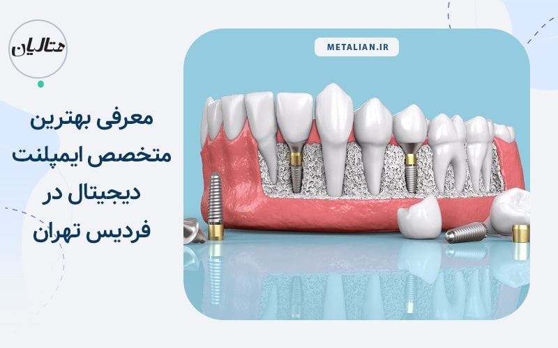 معرفی بهترین متخصص ایمپلنت دیجیتال در فردیس تهران