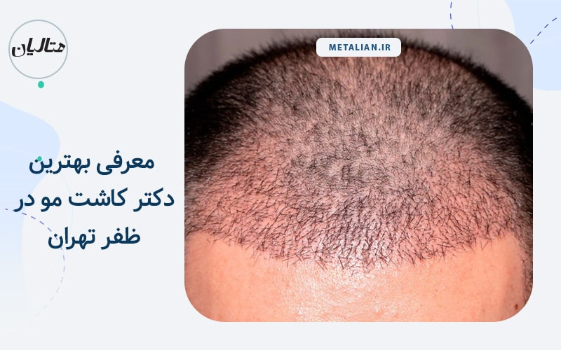 بهترین دکتر کاشت مو