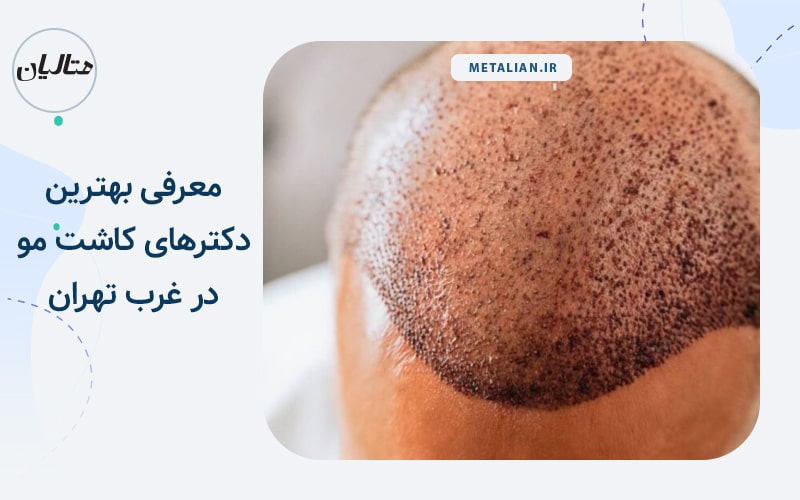 بهترین دکتر کاشت مو در غرب تهران