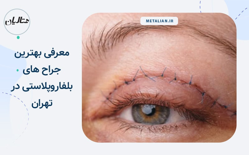 معرفی بهترین جراح های بلفاروپلاستی در تهران