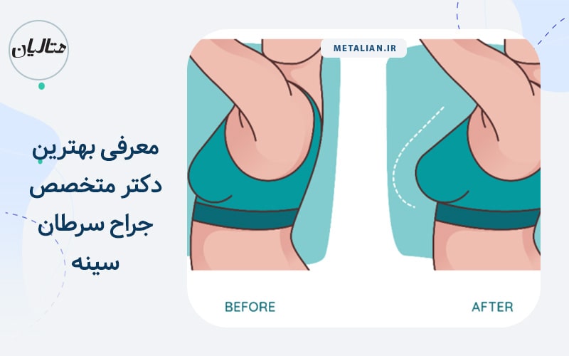 معرفی بهترین دکتر متخصص جراح سرطان سینه