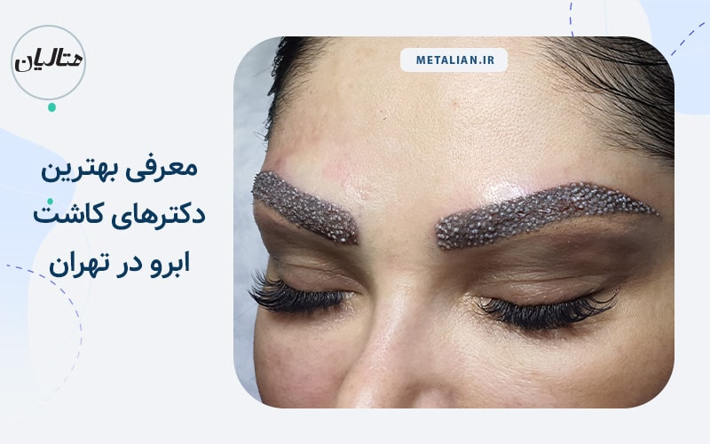 معرفی بهترین دکترهای کاشت ابرو در تهران