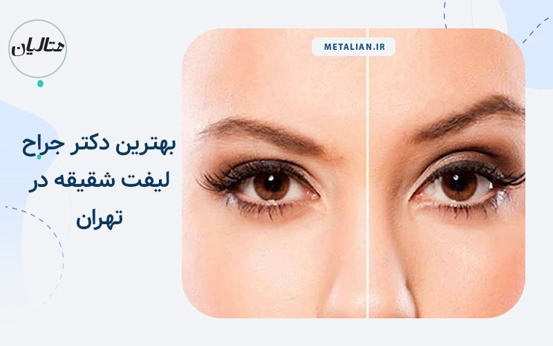 بهترین دکتر جراح لیفت شقیقه در تهران