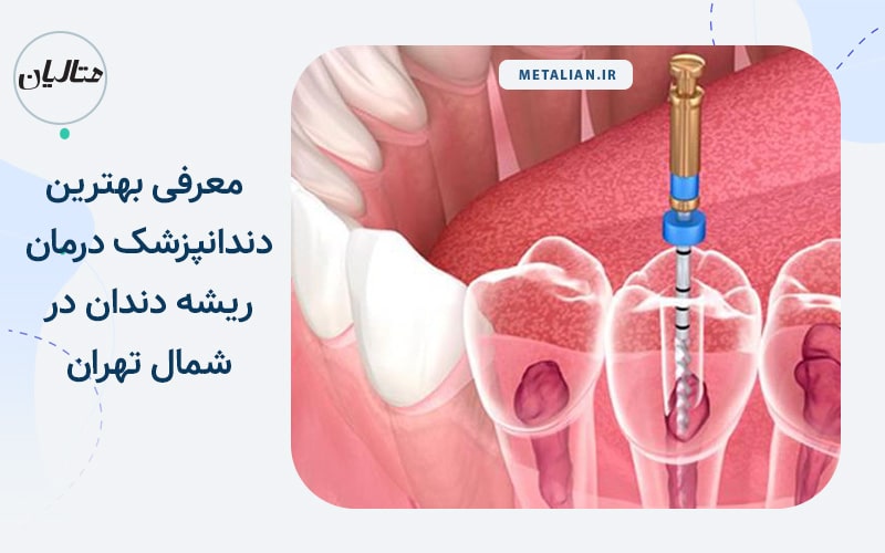 دکتر حسین اکبری معرفی بهترین دندانپزشک درمان ریشه دندان در شمال تهران