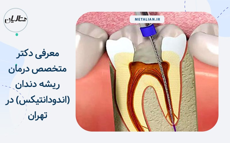 دکتر متخصص درمان ریشه دندان در تهران