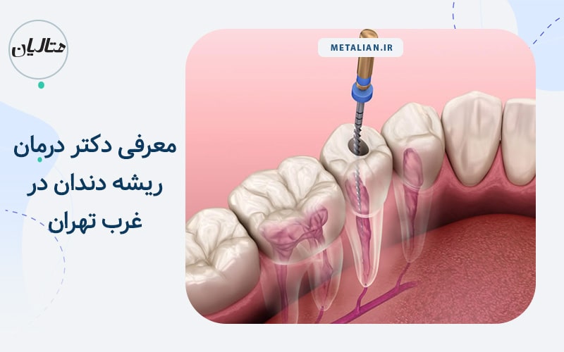 معرفی دکتر درمان ریشه دندان در غرب تهران