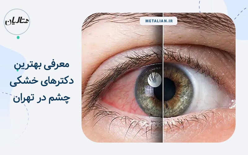 بهترین دکترهای خشکی چشم در تهران