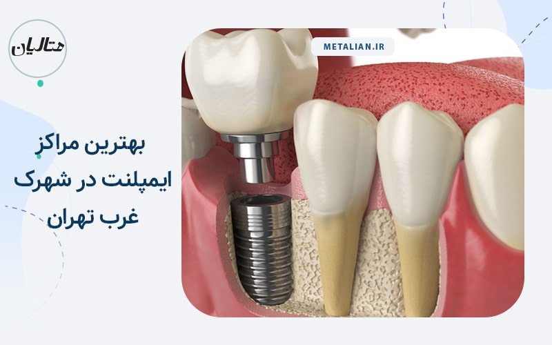 بهترین مراکز ایمپلنت در شهرک غرب تهران