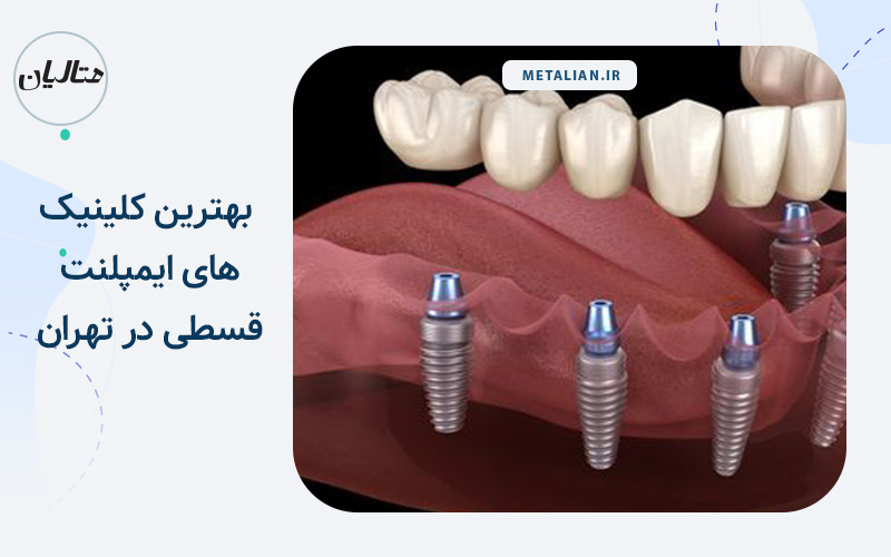بهترین کلینیک های ایمپلنت قسطی در تهران