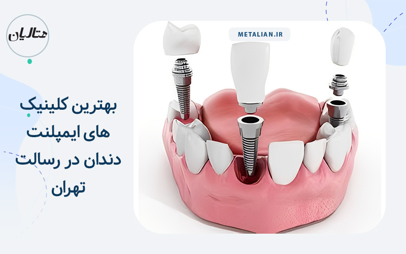 بهترین کلینیک های ایمپلنت دندان در رسالت تهران